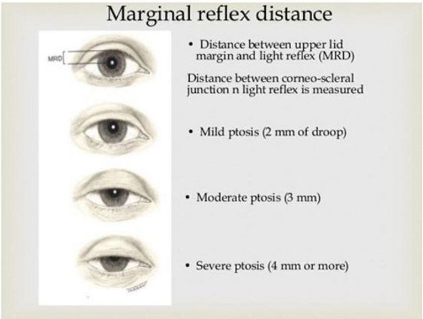 Face Yoga For Droopy Eyelids Using Mobile Tools