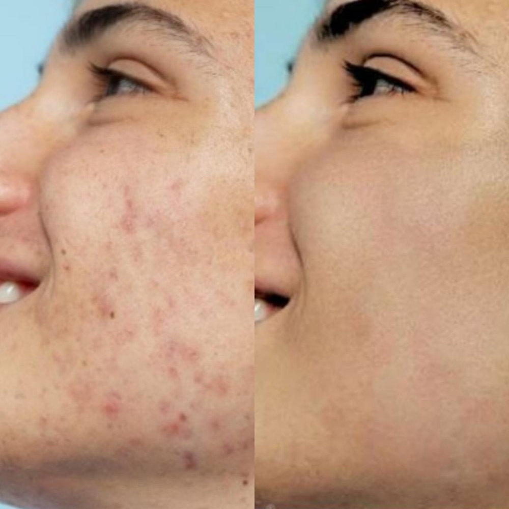 Improve Acne