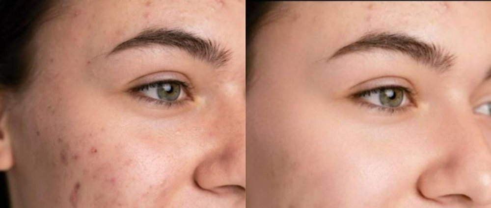 Acne solution