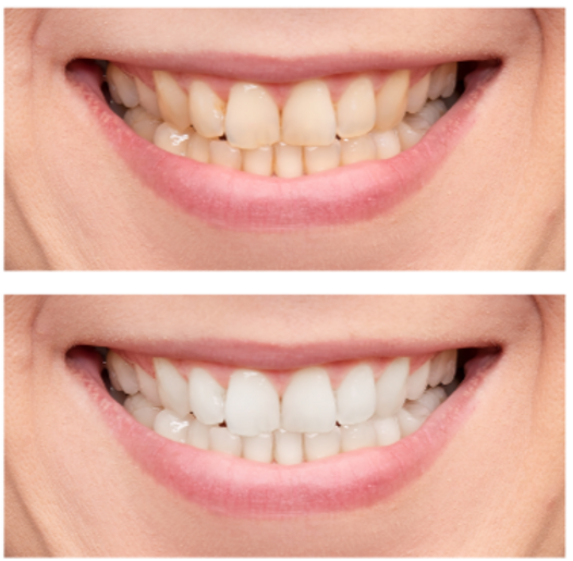 Yellow teeth