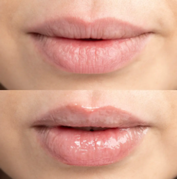  Dry lips