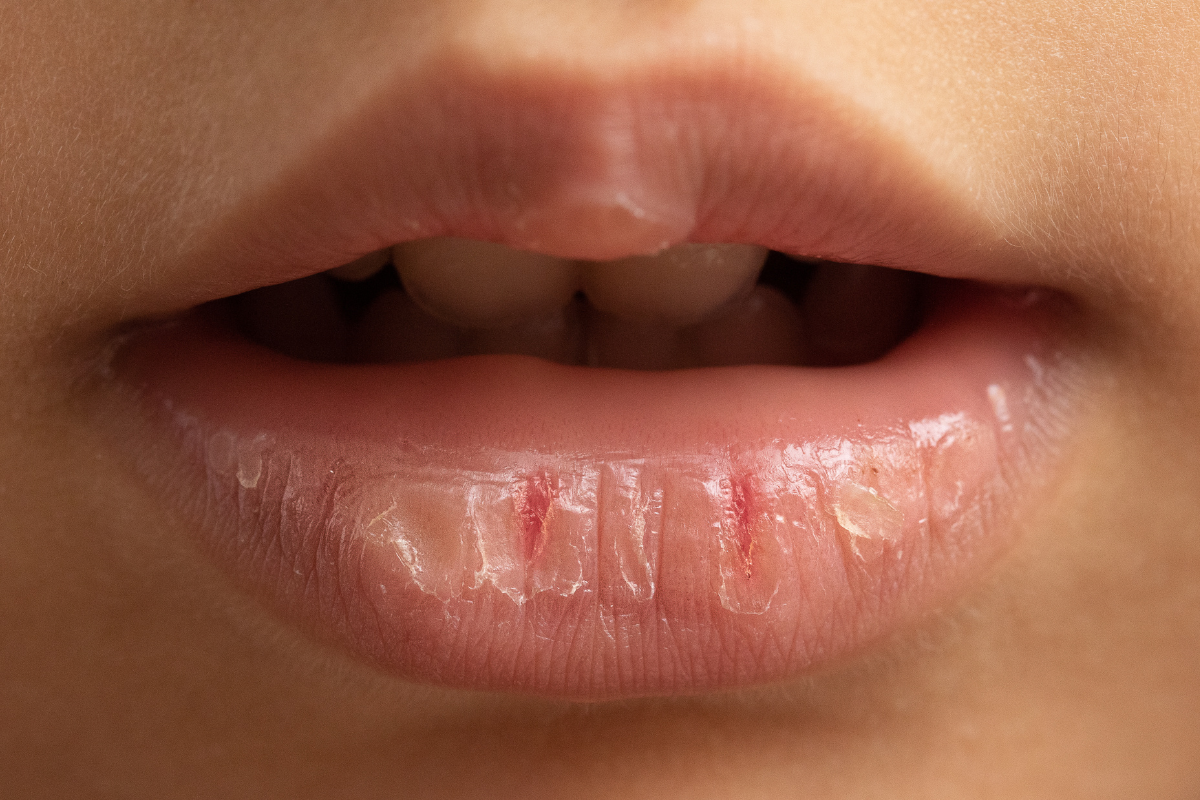 dry lips and hacks to get rid of it