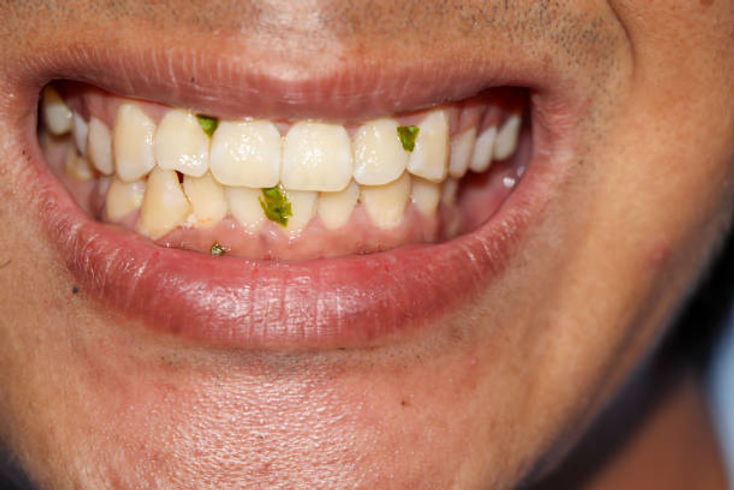 Food stuck on teeth