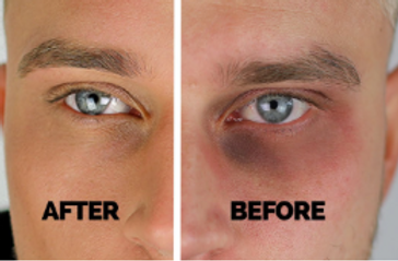 Dark circles before/ after image