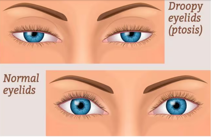Droopy eyes