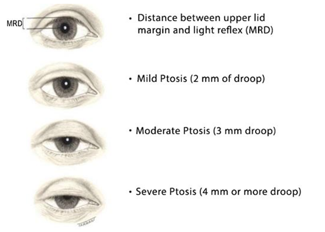 



Droopy eyes

